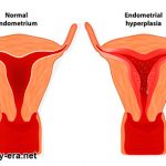 Female Infertility