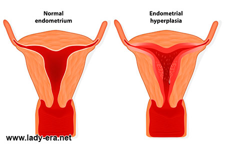 Endometriosis