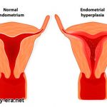 Uterine Hypoplasia