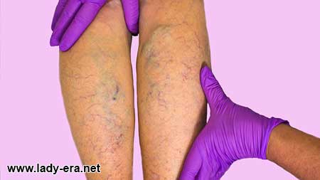 Varicose Veins