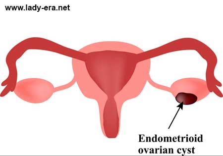 endometriotic cyst