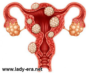 Endometriosis Causes