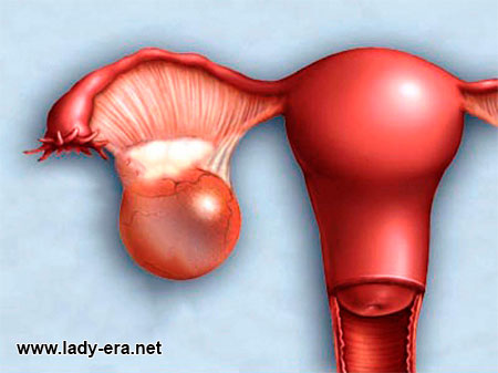 dangers of ovarian cysts