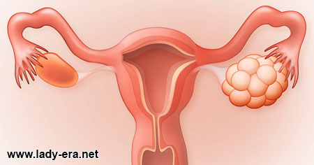 Polycystic ovaries