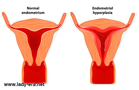 Uterine Hypoplasia
