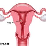 Polyps of endometrium