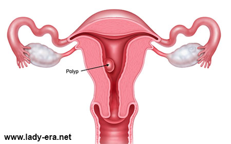 Polyps of endometrium