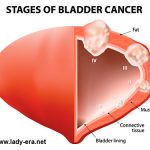 Bladder Cancer