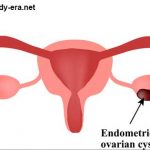 Cystic Endometrioma