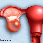 ovarian cysts