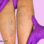 Varicose Veins